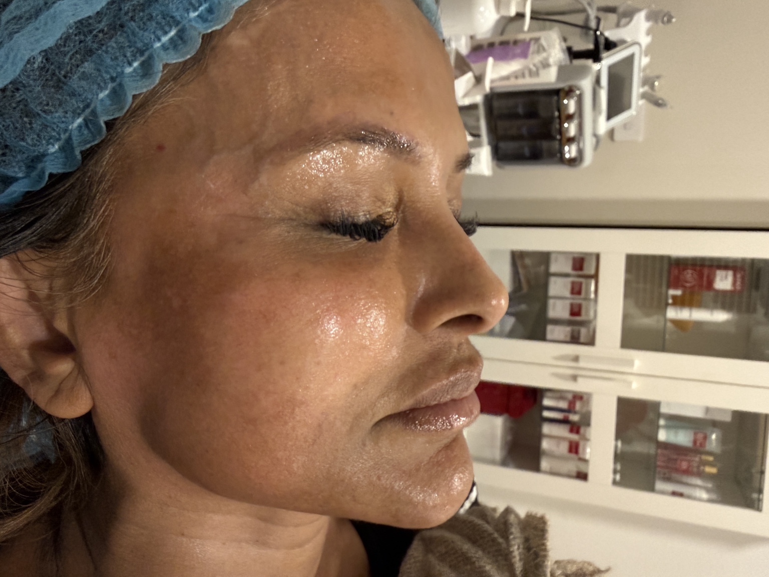 Client after her personalised pigmentation care journey, wearing a blue hair cap in the clinic