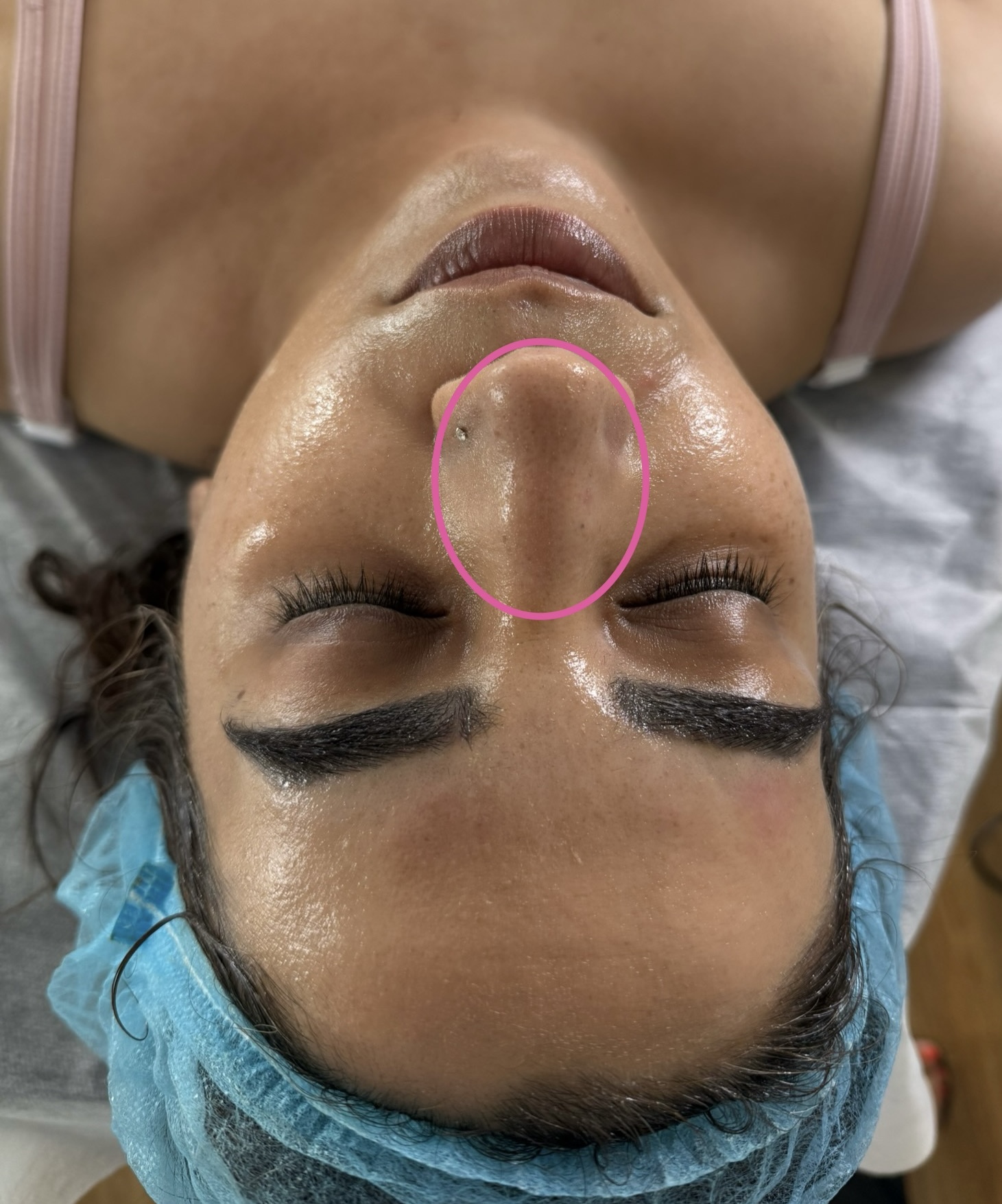 Client-supplied after photo following one Hydra Peeling session, showing the nose area marked with a pink circle