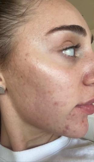 Client-supplied left view before skin needling