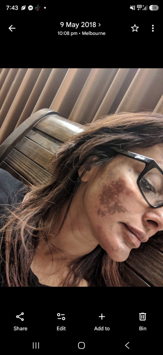 Historical client-supplied before photo, wearing glasses, showing cheek pigmentation; dated 9 May 2018